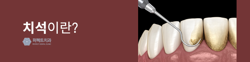 치석 제거는 스케일링으로! 관련 이미지 2