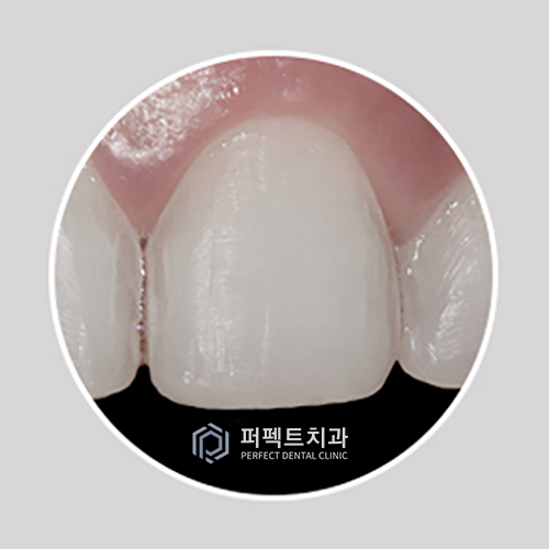 강남치과 무삭제라미네이트비용 관련 이미지 4