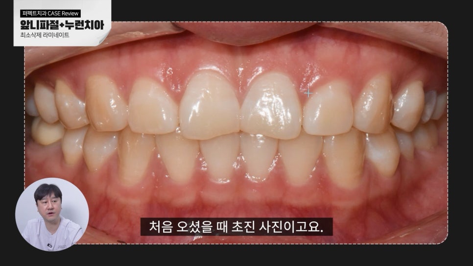 깨진앞니+나비치아 무삭제라미네이트 관련 이미지 2