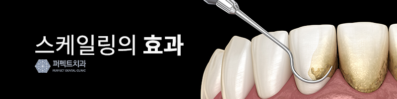 스케일링 후 주의사항과 오해 관련 이미지 2