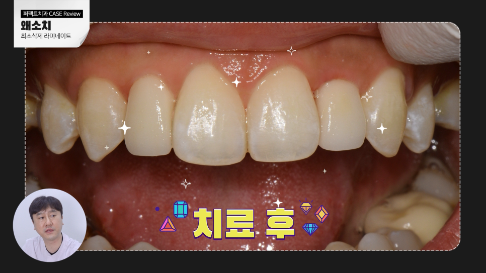 왜소치 라미네이트? 교정? 간단한 치료방법은 관련 이미지 4