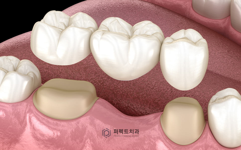 컴퓨터 분석을 통한 임플란트 관련 이미지 2
