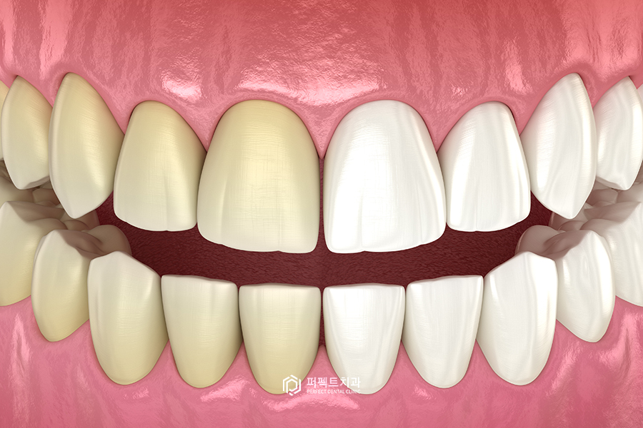 치아미백｜통증, 주기, 주의사항 관련 이미지 1