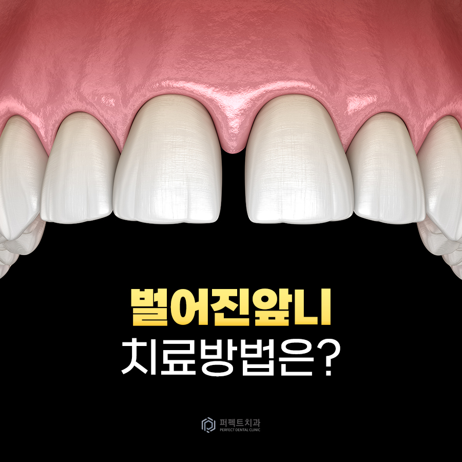벌어진 앞니 치료 방법은? 관련 이미지 1