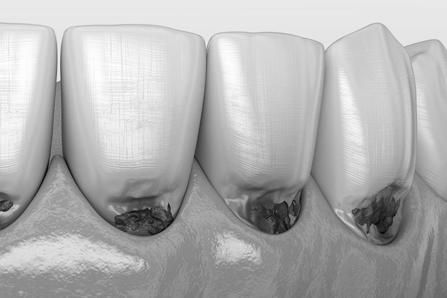 치경부마모증, 치료 미루지마세요! 관련 이미지 1