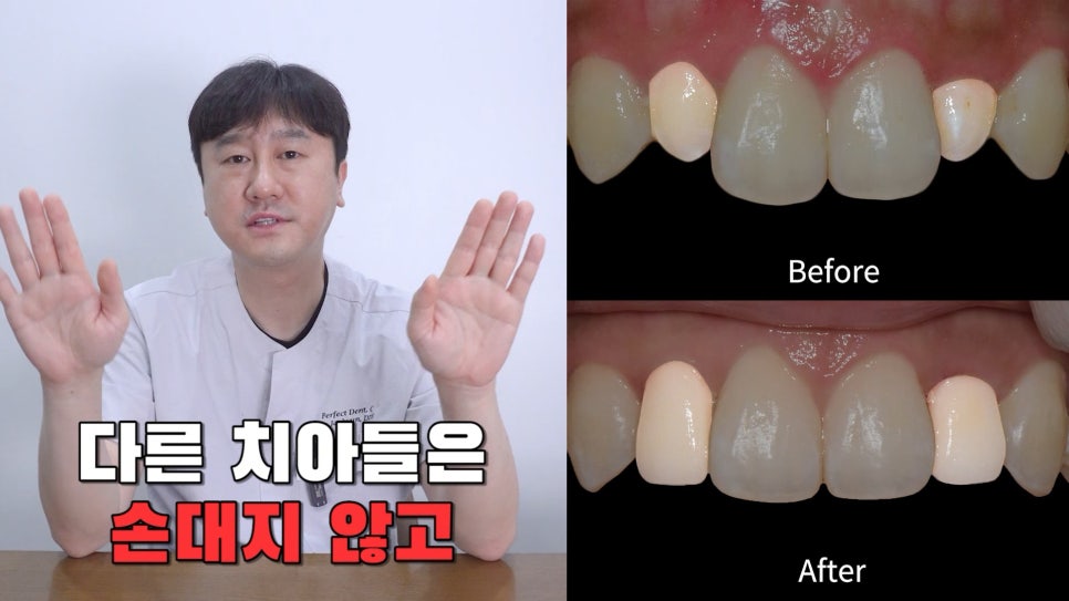 주변 치아보다 작은 관련 이미지 9