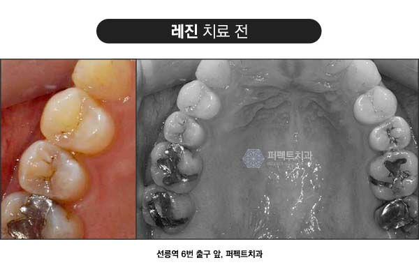 치과 충치치료비용 관련 이미지 2