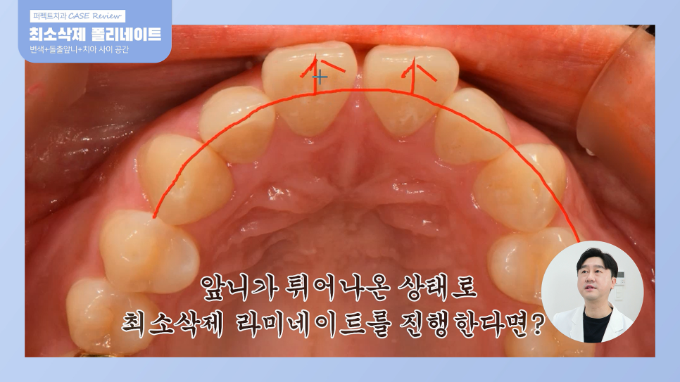 앞니 돌출,벌어짐,변색.. 교정이 싫다면 이 방법으로!? 관련 이미지 4