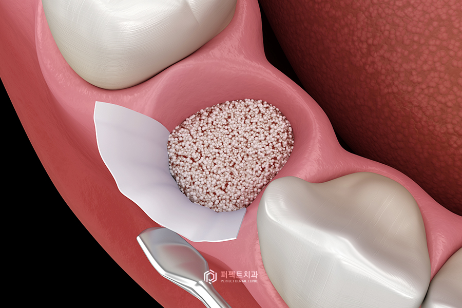 뼈이식 임플란트, 뼈의 종류는?! 관련 이미지 1