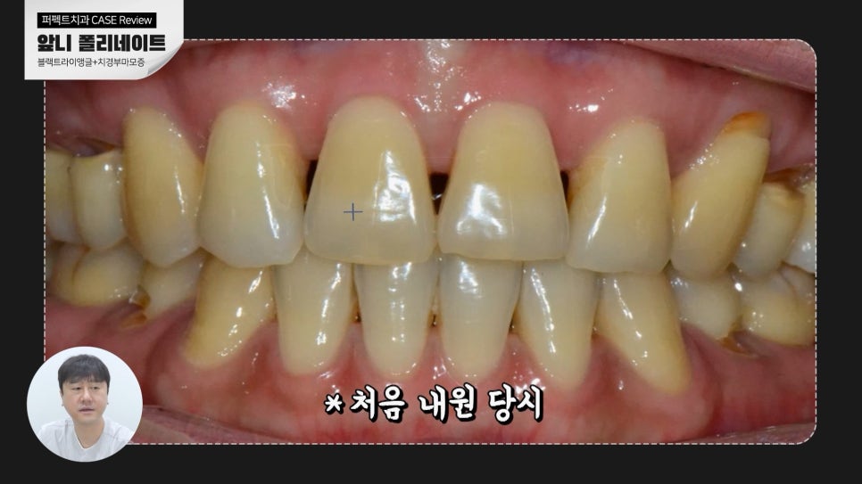 블랙트라이앵글+노란치아 폴리네이트 case 관련 이미지 2