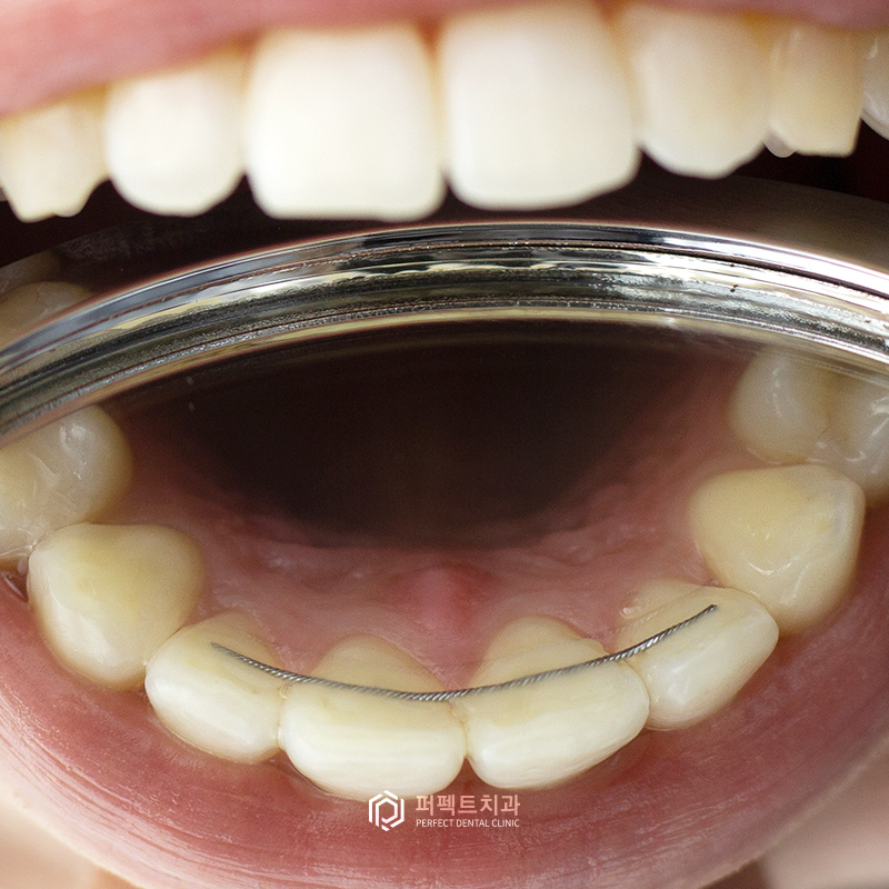 라미네이트 후 치아교정 시 알아아야 할 점은? 관련 이미지 4