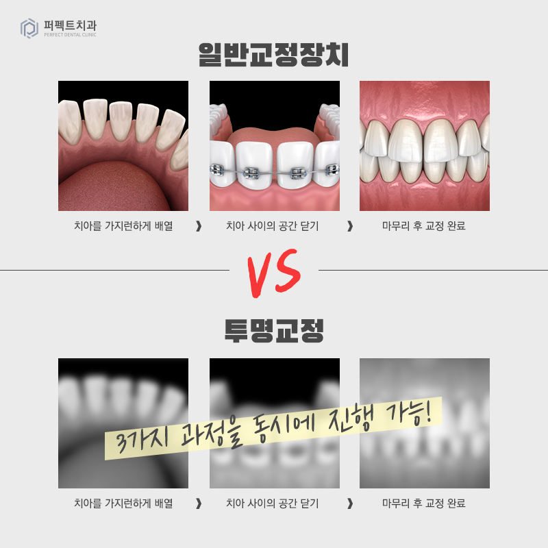투명교정은 일반교정보다 효과가 떨어지나요? 관련 이미지 3