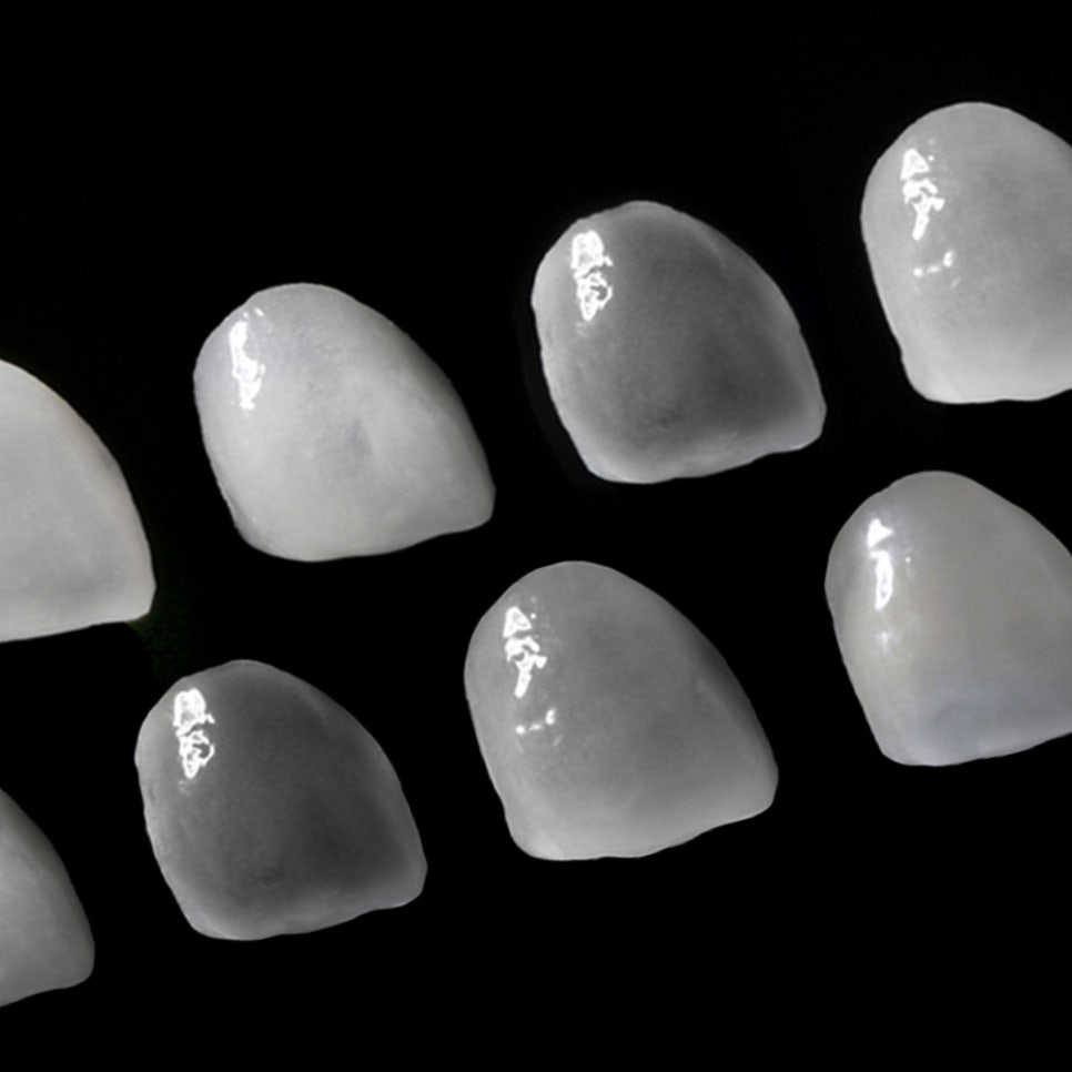 라미네이트 치료 시 참고사항은? 관련 이미지 1