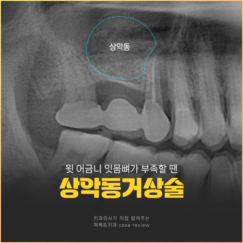 임플란트를 해야하는데 상악동에 염증이..😭 관련 이미지 1