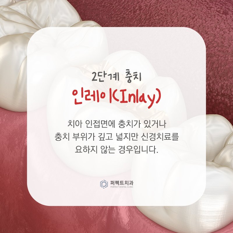 충치치료 단계와 치료방법 알아보기 관련 이미지 4