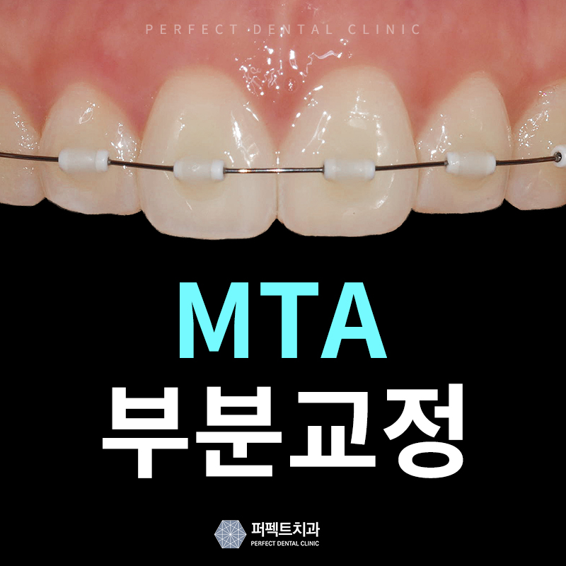 MTA부분교정으로 단기간 교정끝내기 관련 이미지 1