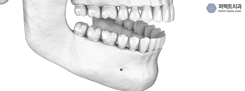 긴턱 치아교정, 턱변화 비교 관련 이미지 2