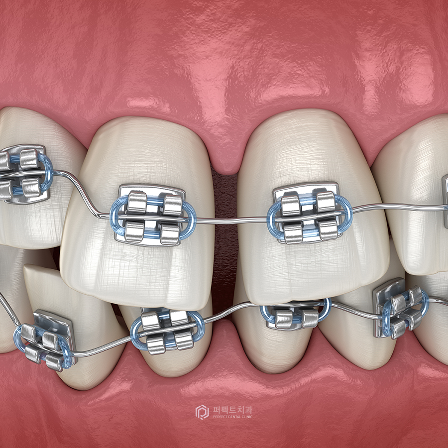 벌어진 앞니 치료 방법은? 관련 이미지 2
