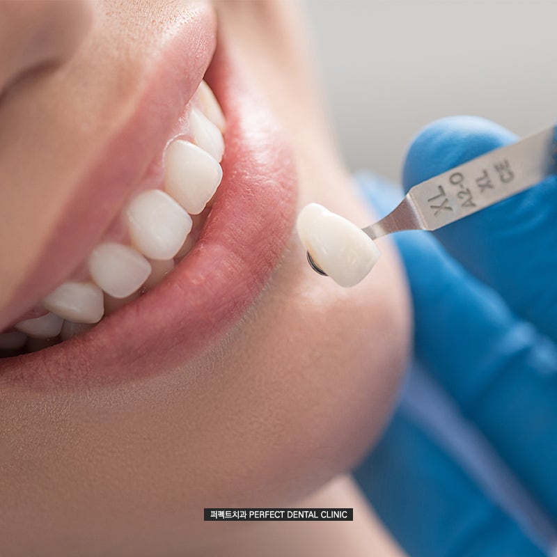 치아미백 후 주의사항(feat.과정, 통증) 관련 이미지 3