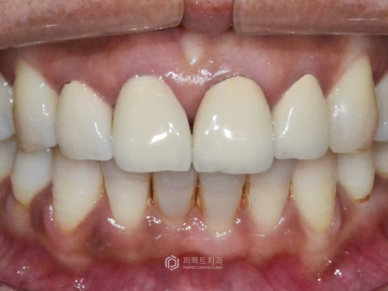 라미네이트시 신경치료 안해도 잇몸이 까매지나요? 관련 이미지 4