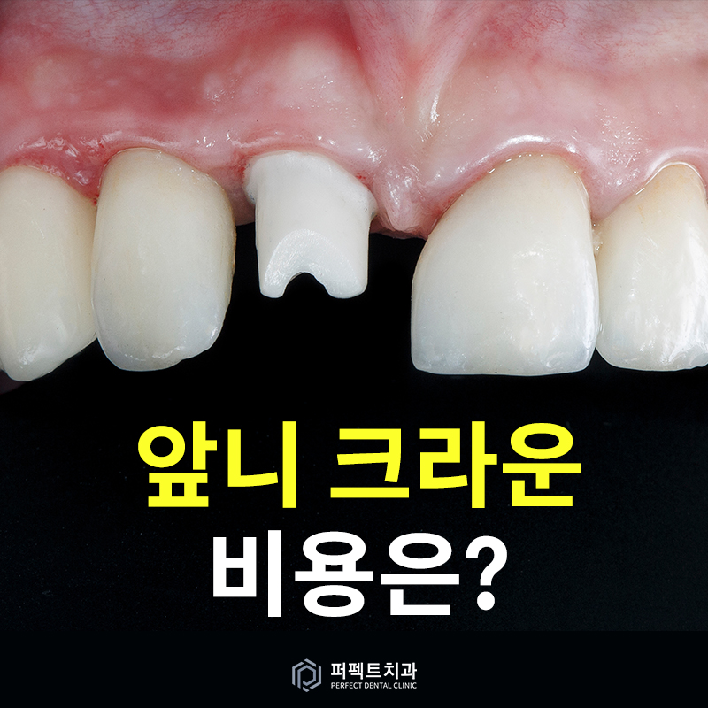 앞니 크라운 종류와 비용 관련 이미지 1