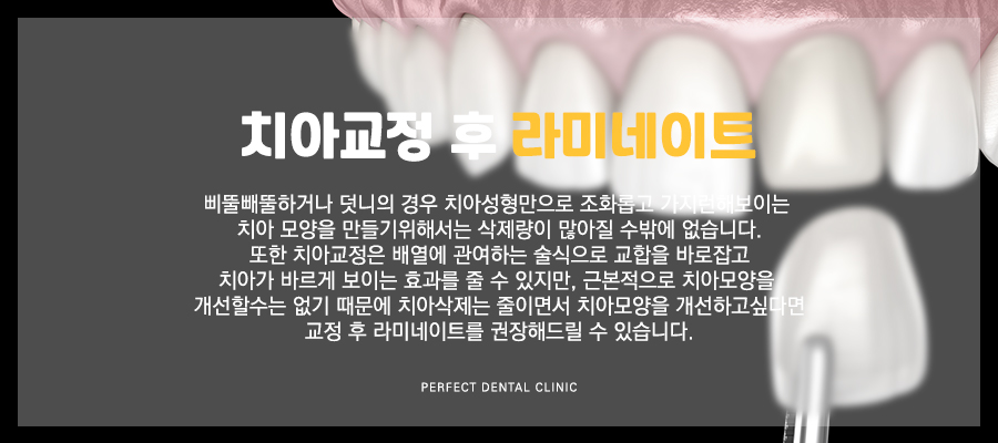 치아교정 후 치아모양이 마음에 들지않으면? 관련 이미지 5