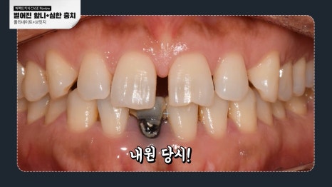 벌어진 앞니 무삭제라미네이트! 관련 이미지 1