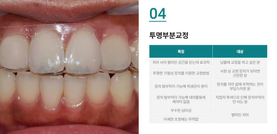 벌어진앞니교정, 원인부터 해결 방법까지 관련 이미지 8