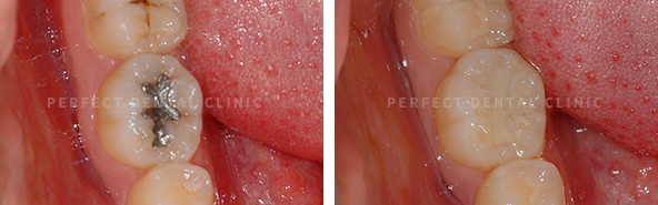 강남 충치치료비용 알고가자! 관련 이미지 2