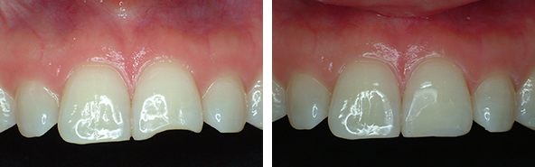 앞니 레진 변색 비용 얼마? 관련 이미지 3