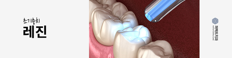 충치치료 레진 비용 얼마? 관련 이미지 2