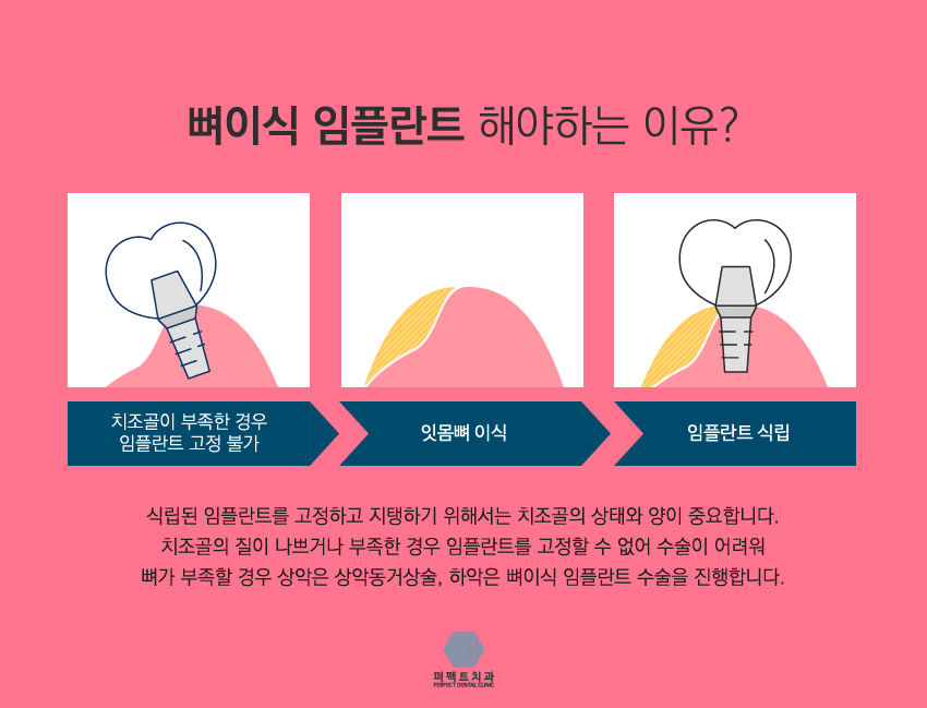 뼈이식임플란트란 뭘까? 관련 이미지 2