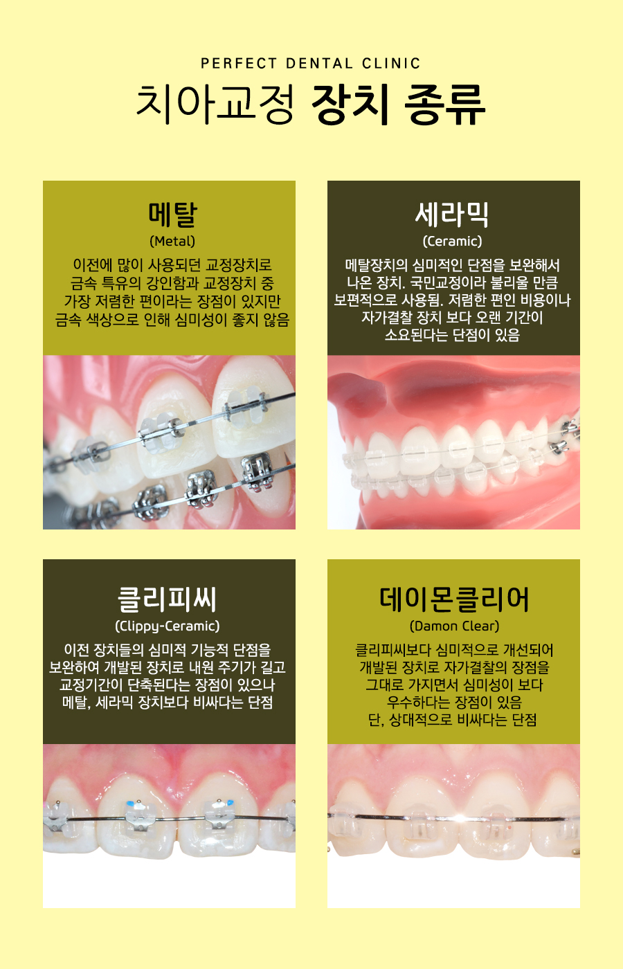 치아교정 장치종류! 관련 이미지 2