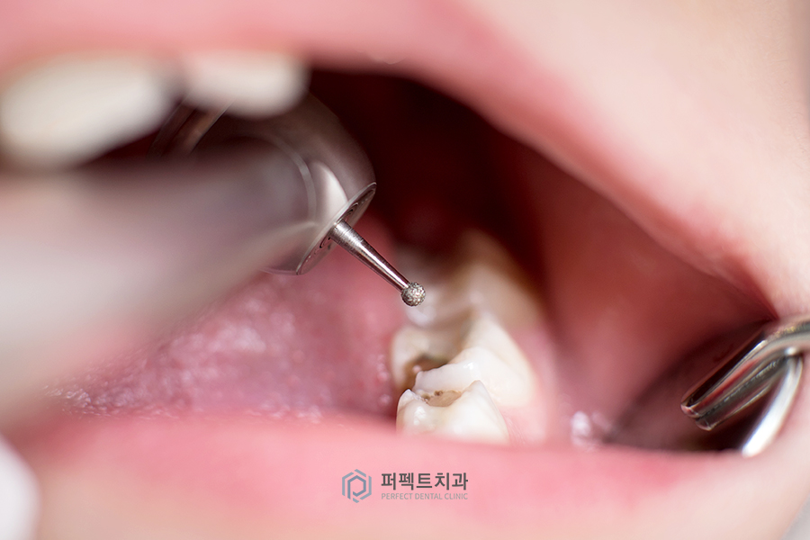 ✨신경치료 질문 BEST① 관련 이미지 1