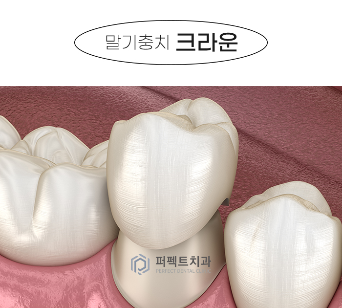 미룰수록 어려운 충치치료, 초기에 치료해요! 관련 이미지 7