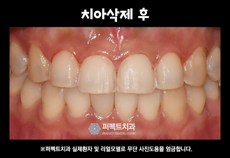 앞니 라미네이트 관련 이미지 6