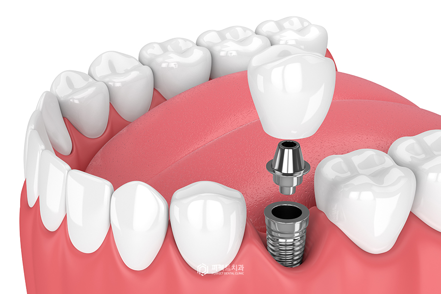 임플란트 보철 탈락①｜크라운이 빠지는 이유는? 관련 이미지 2