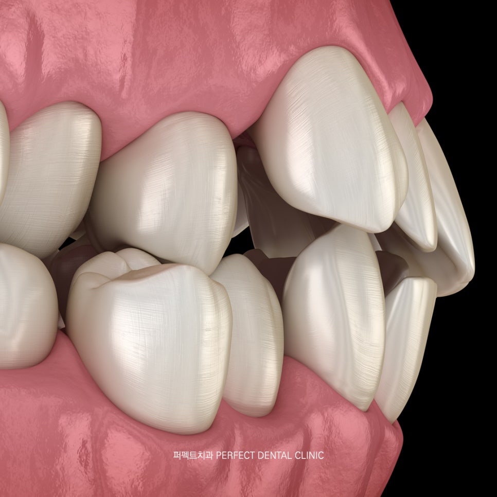 라미네이트 후 부작용은 어떤게 있을까? 관련 이미지 4
