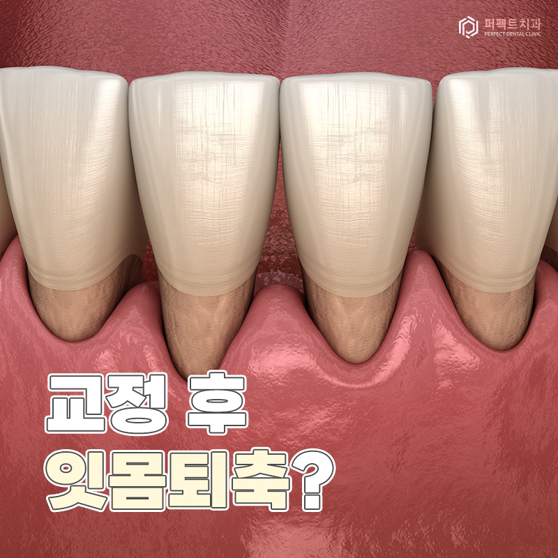 교정 후 잇몸퇴축은 흔하게 생기나요? 관련 이미지 1