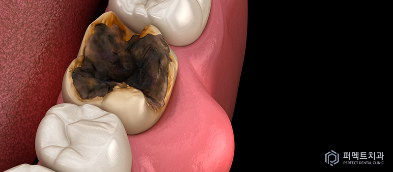 충치방치해 신경치료 진행 관련 이미지 1