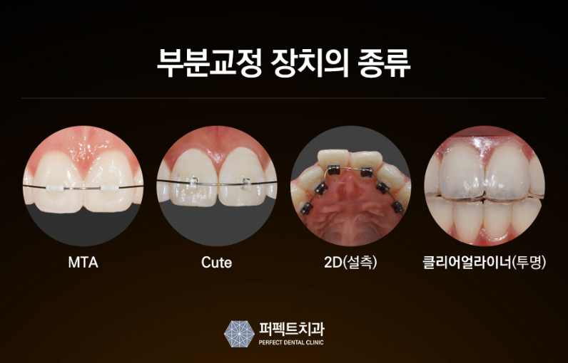 치아단기교정, 과연 얼마나 걸릴까? 관련 이미지 3