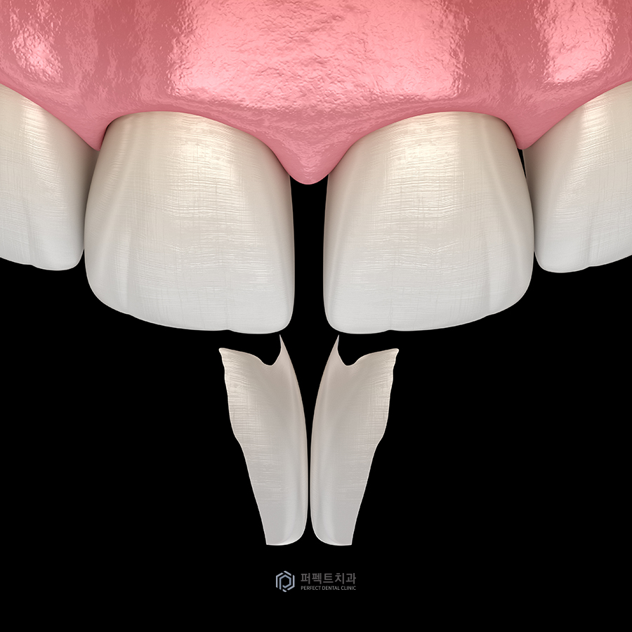 벌어진 앞니 치료 방법은? 관련 이미지 4