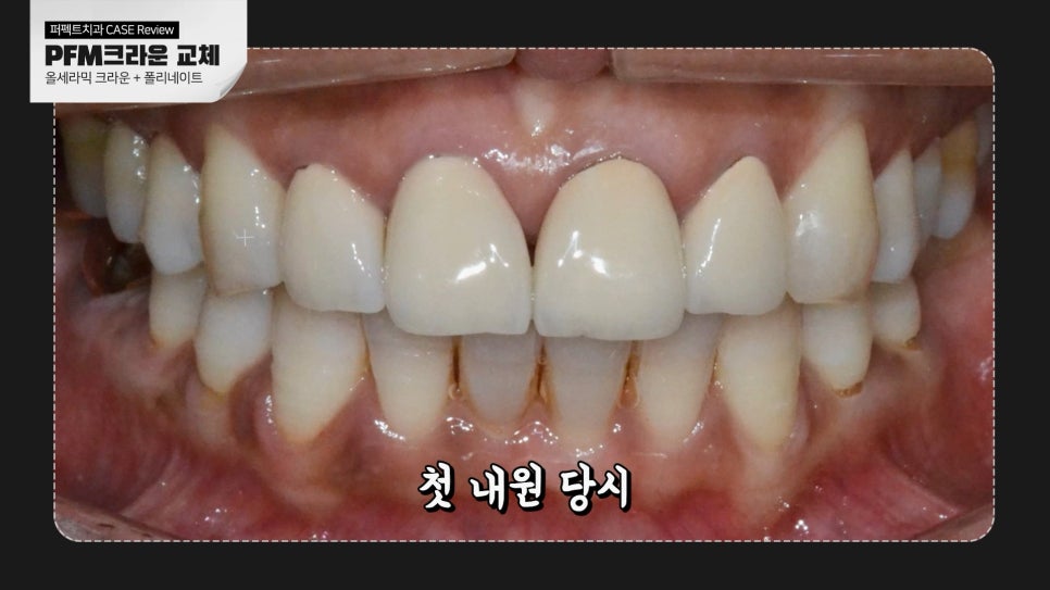 PFM크라운&rarr;라미네이트, 크라운 교체 케이스 관련 이미지 2