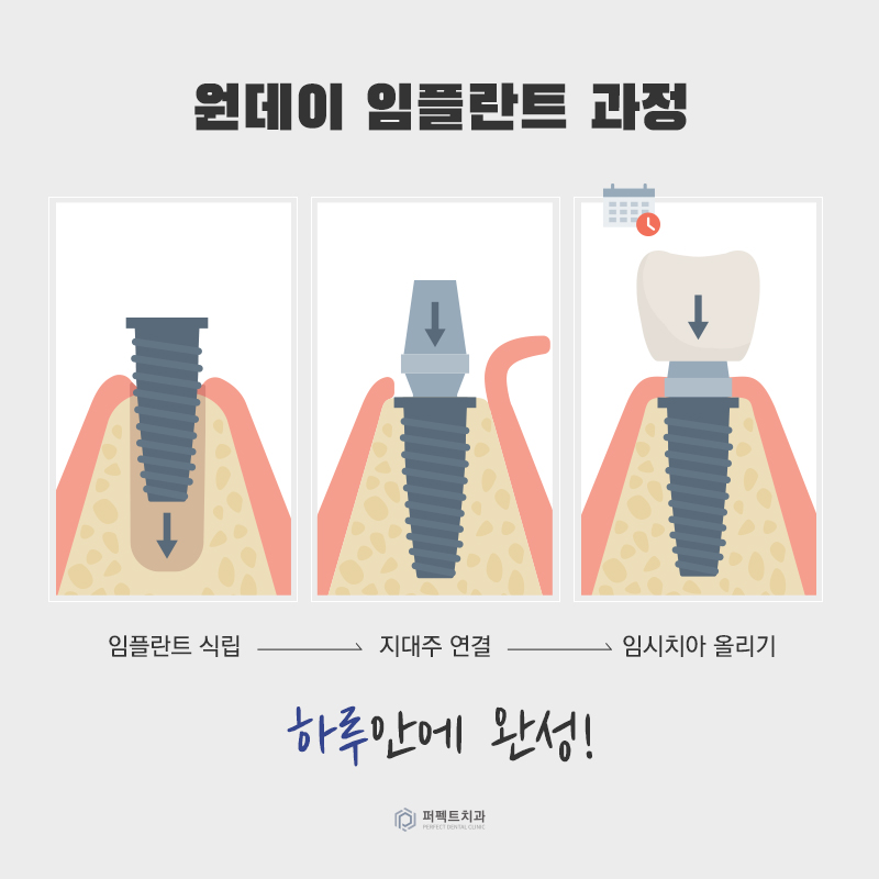 컴퓨터 분석을 통한 임플란트 관련 이미지 8