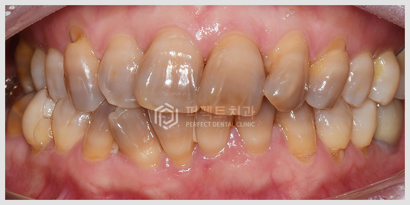 테트라사이클린 치아변색 치료 관련 이미지 2