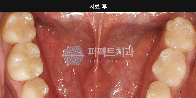 지르코니아 크라운 가격 궁금해? 관련 이미지 4