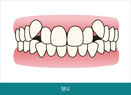 비발치로 덧니,개방교합 교정하기! 관련 이미지 2