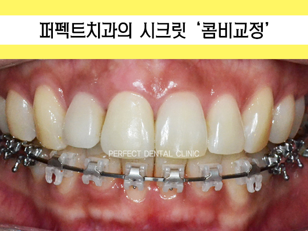윗니는 설측으로 보이지 않게, 콤비교정으로 쉿크릿 치아교정! 관련 이미지 1