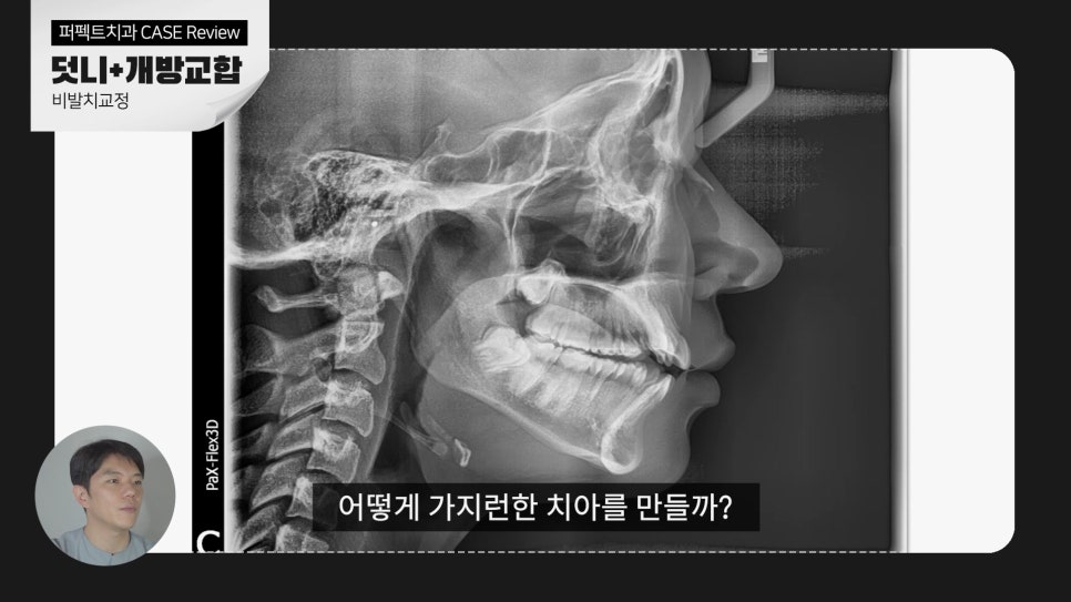 덧니+개방교합, MARPE를 이용한 비발치교정 관련 이미지 3
