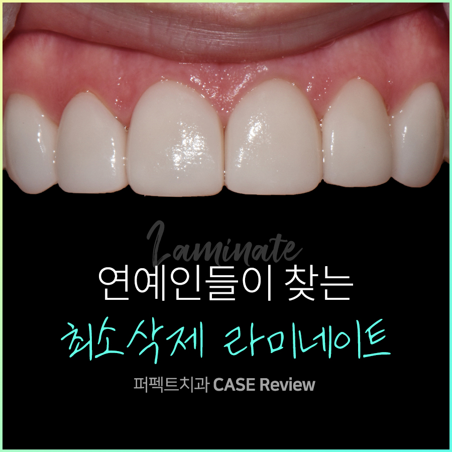 연예인 라미네이트, 최소삭제 라미네이트로! 관련 이미지 1